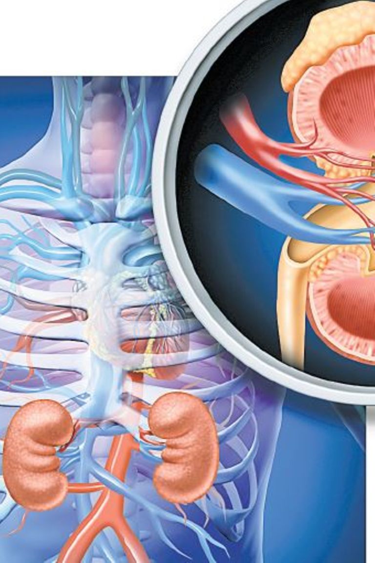 Nine reasons that can lead to kidney transplant failure - The Citizen