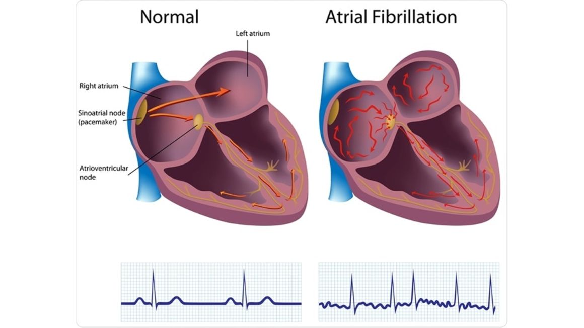 fibrilliation pic