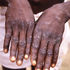 Monkeypox.
