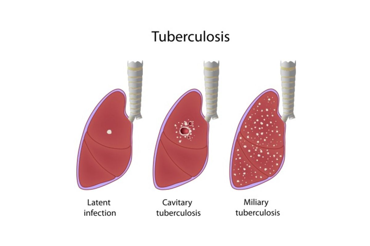 Traditional healers’ role in TB prevention, control | The Citizen