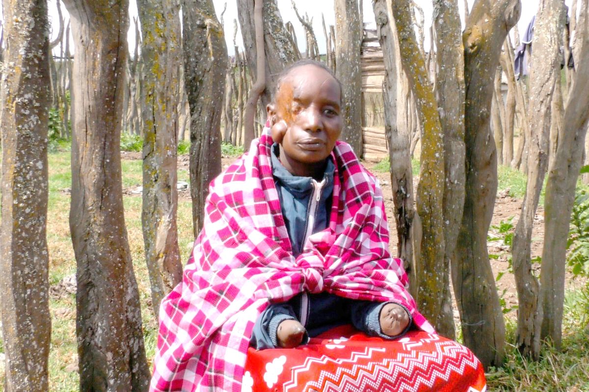 how-a-50-year-old-woman-is-coping-years-after-brutal-hyena-attack-the