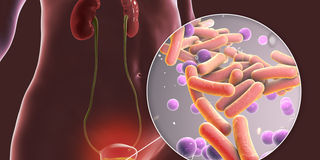 UTIs